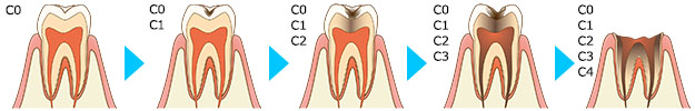 むし歯の進行図